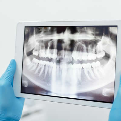 Facial fractures